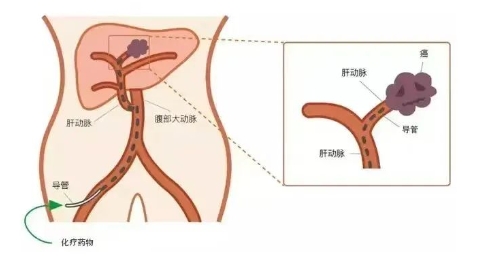 中晚期肝癌治療新選擇：肝動脈灌注化療（HAIC）