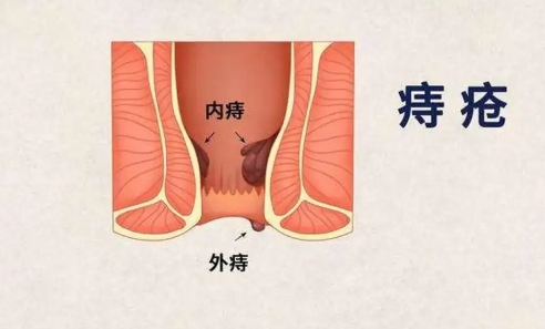 五院專家講堂 | 專家提醒您，別拿痔瘡不當(dāng)回事！