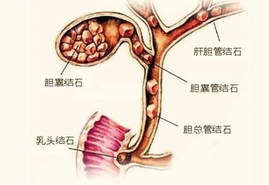 市五院多學(xué)科聯(lián)動 ERCP治療七旬膽梗阻患者化“阻”為通